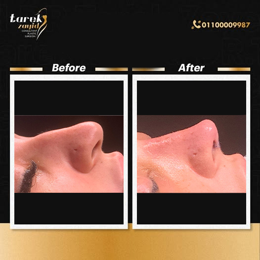 علامات جمال الأنف